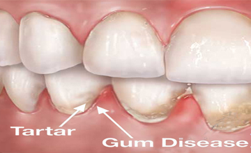 Kemah Family Dental Periodontal (Gum) Disease service