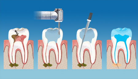 Kemah Family Dental Endodontics  Therapy service
